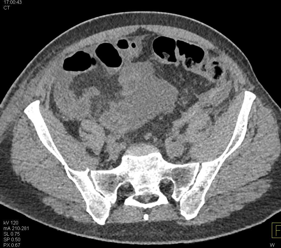 CT Cystogram with Bladder Perforation from Urethra Bladder Junction - CTisus CT Scan