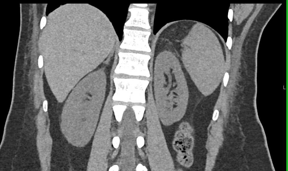 Polypoid Bladder Cancer - CTisus CT Scan