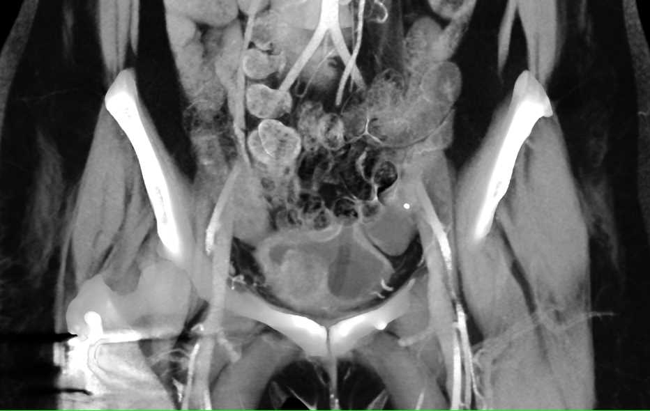 Polypoid Bladder Cancer - CTisus CT Scan