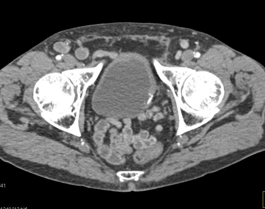 Incidental Carcinoma on Left Bladder Wall - CTisus CT Scan