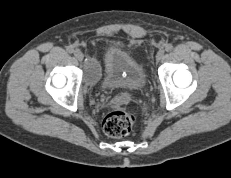 CT Cystogram with Bladder Leak Following Prostatectomy - CTisus CT Scan