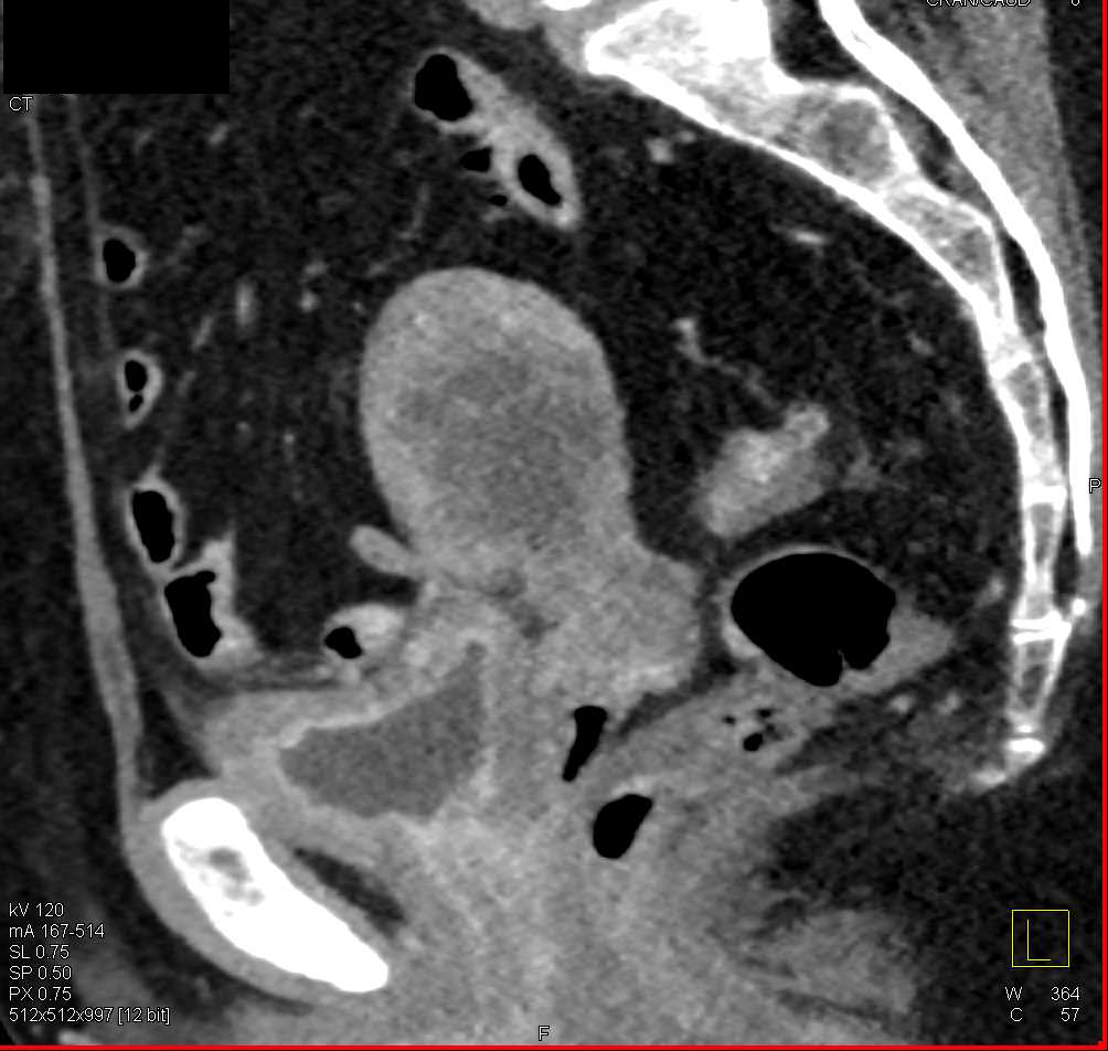 Acute Cystitis - CTisus CT Scan