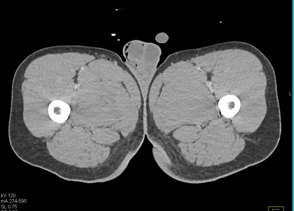 Scrotal Trauma with Injured Right Testis - CTisus CT Scan