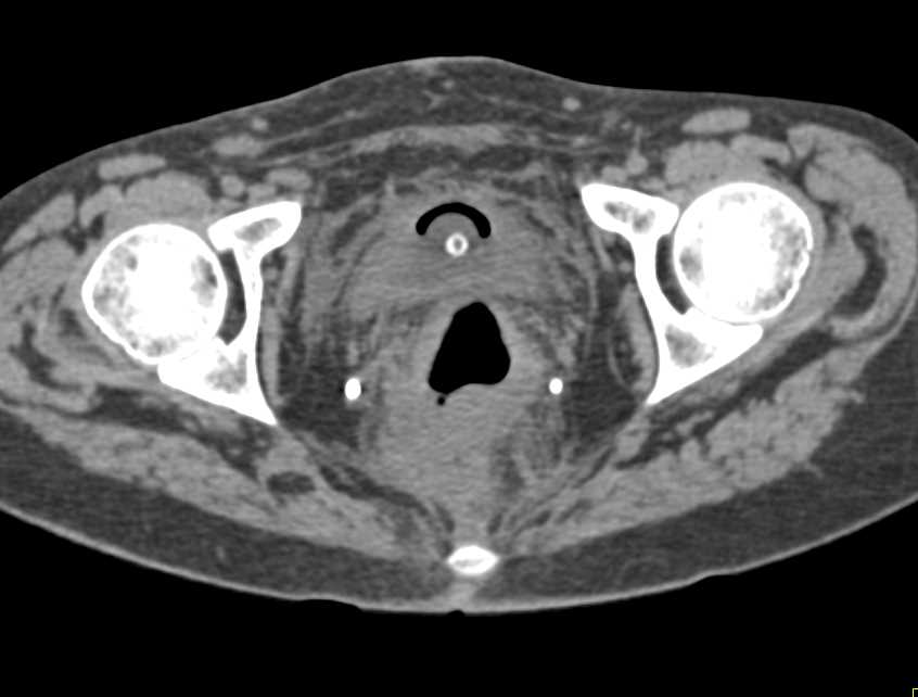 Fistulae off the Dome of the Bladder - CTisus CT Scan