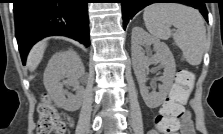 Tumor Seen in Proximal Left Ureter - CTisus CT Scan