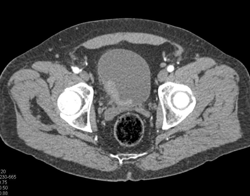 Aggressive Bladder Cancer of Right Bladder Wall - CTisus CT Scan