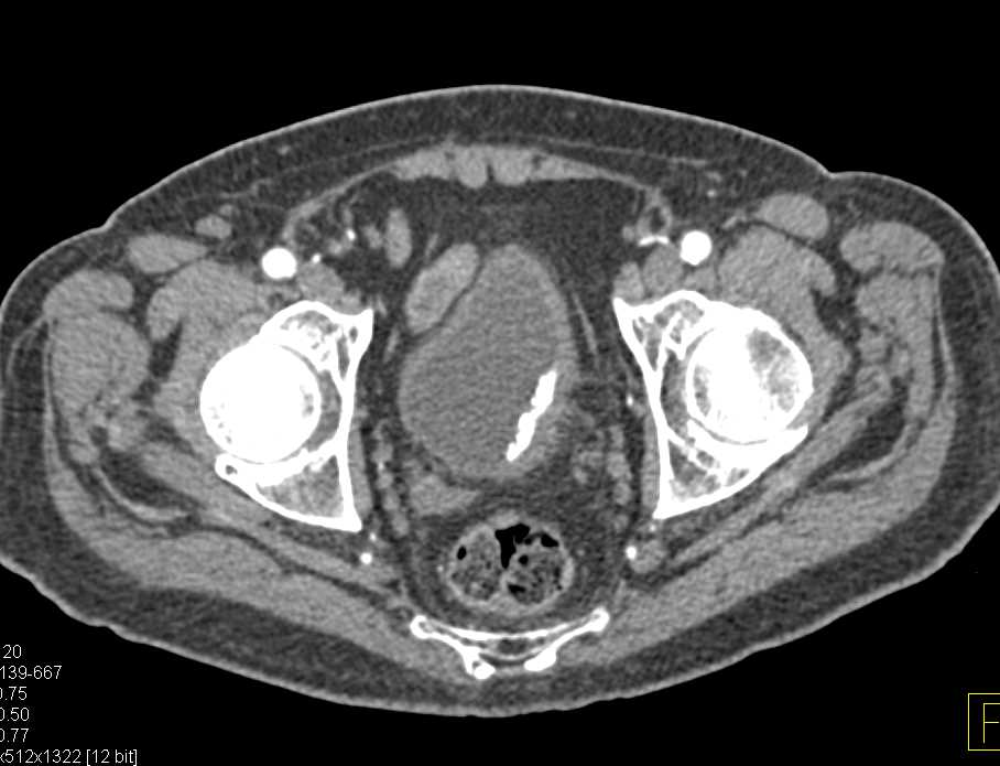 Partially Calcified Bladder Cancer - CTisus CT Scan