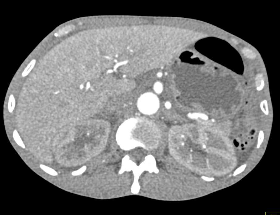 Scrotal Abscess with Incarcerated Hernia - CTisus CT Scan