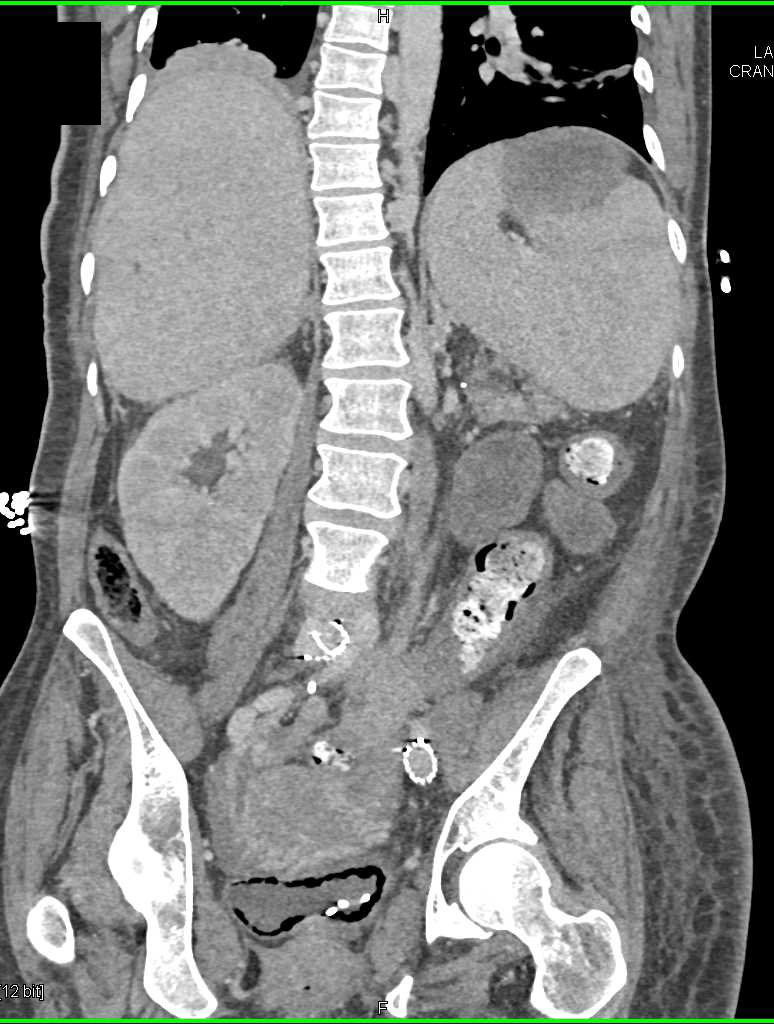 Emphysematous Cystitis - CTisus CT Scan