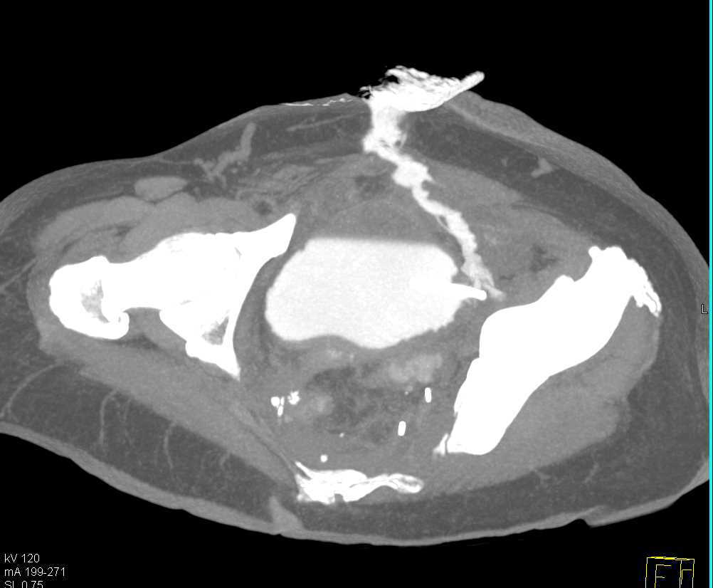 Fistulae from Bladder Through Abdominal Wall - CTisus CT Scan