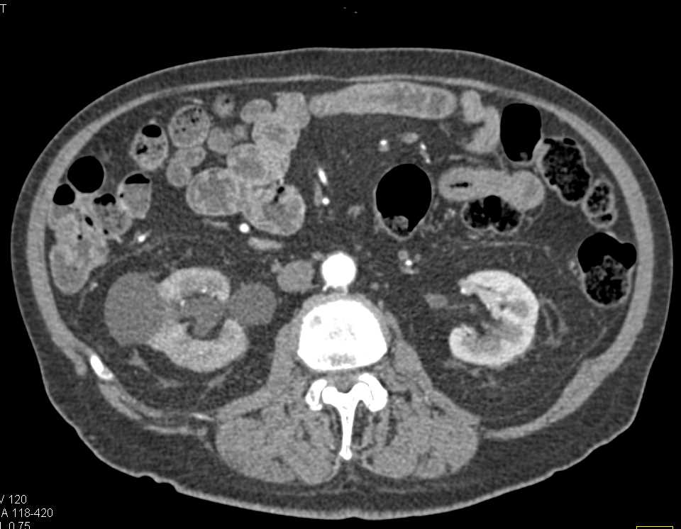 Bladder Cancer Causes Right Hydronephrosis - CTisus CT Scan