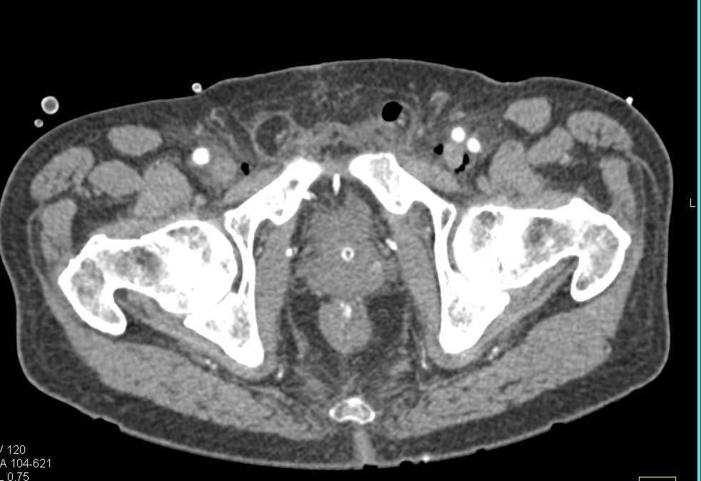 Changes Pelvis Post Prostatectomy - CTisus CT Scan