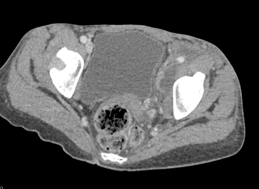 Necrotic Nodes in Left Inguinal Zone with Extension Upward due to Mycobacterium avium/intracellulare (MAI) Infection - CTisus CT Scan