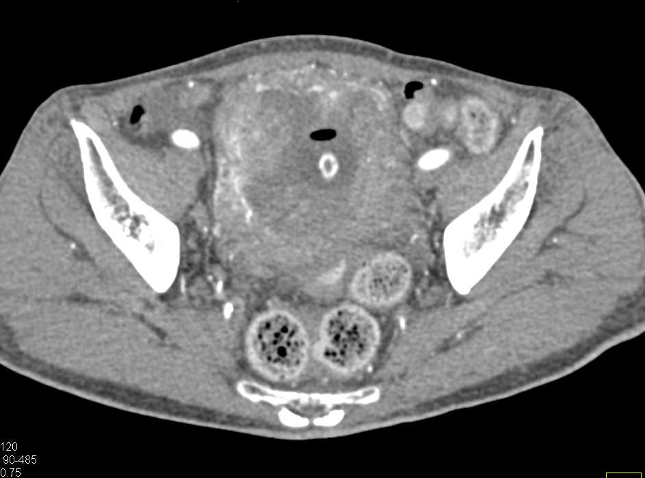 Impressive Bladder Cancer with Neovascularity - CTisus CT Scan