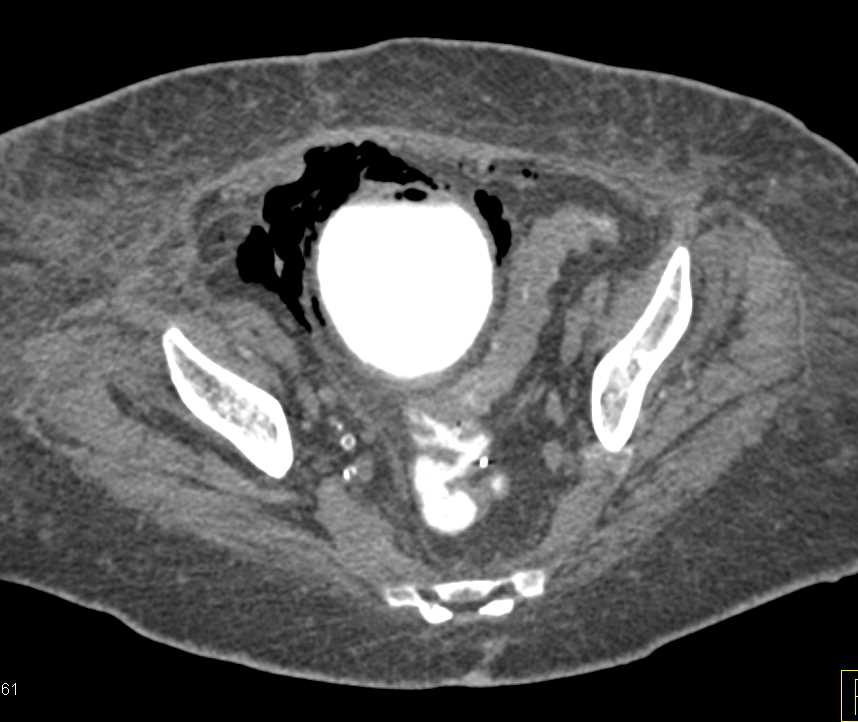 Emphysematous Cystitis - CTisus CT Scan