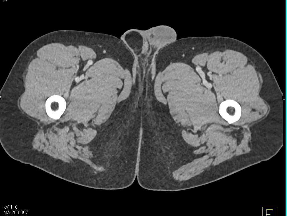 Fat Herniating Into The Scrotum - CTisus CT Scan