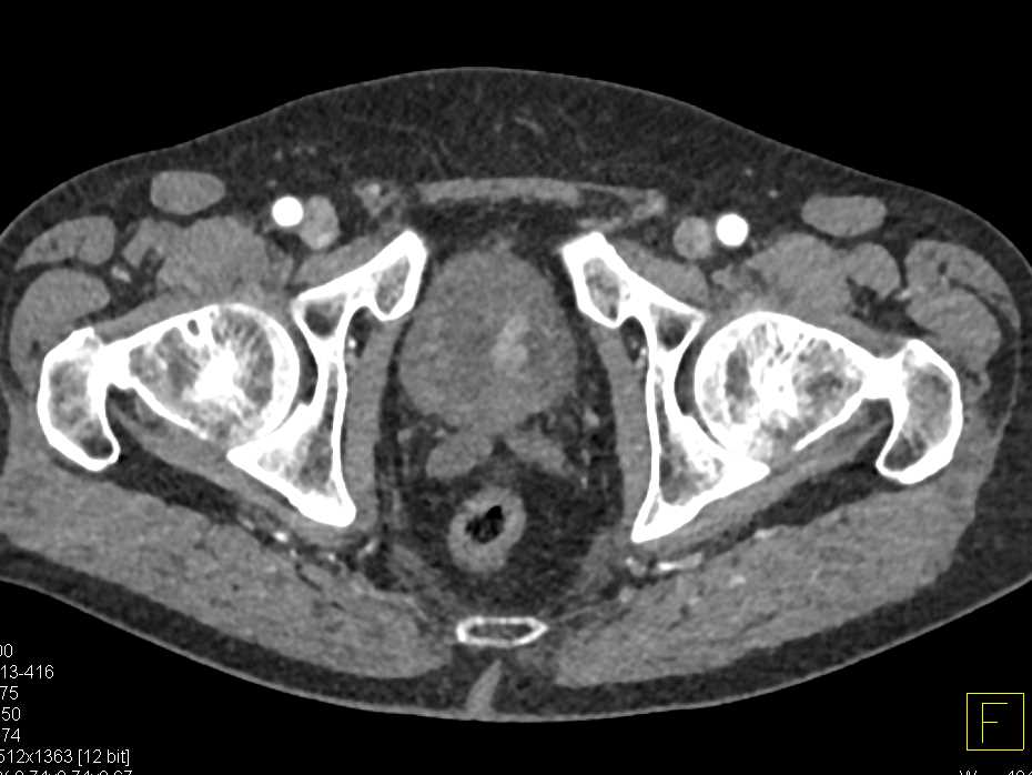 Bladder Wall Thickening Following Prostate Cancer Radiotherapy - CTisus CT Scan