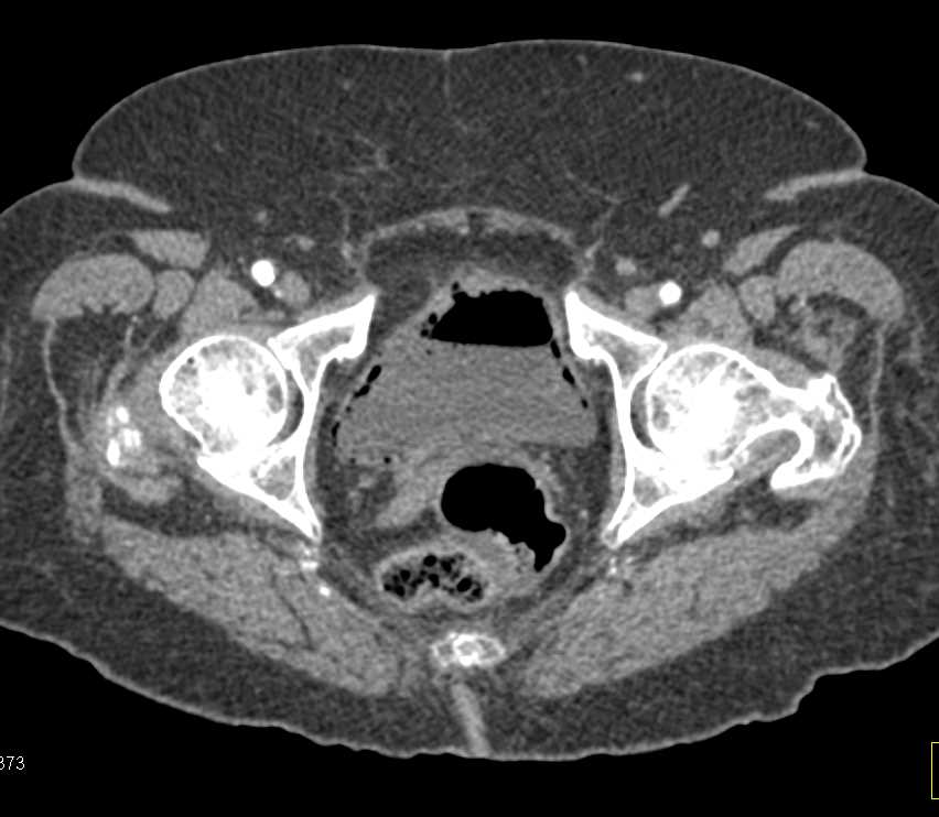 Emphysematous Cystitis - CTisus CT Scan