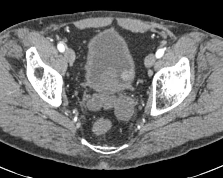 Multifocal Bladder Cancer - CTisus CT Scan