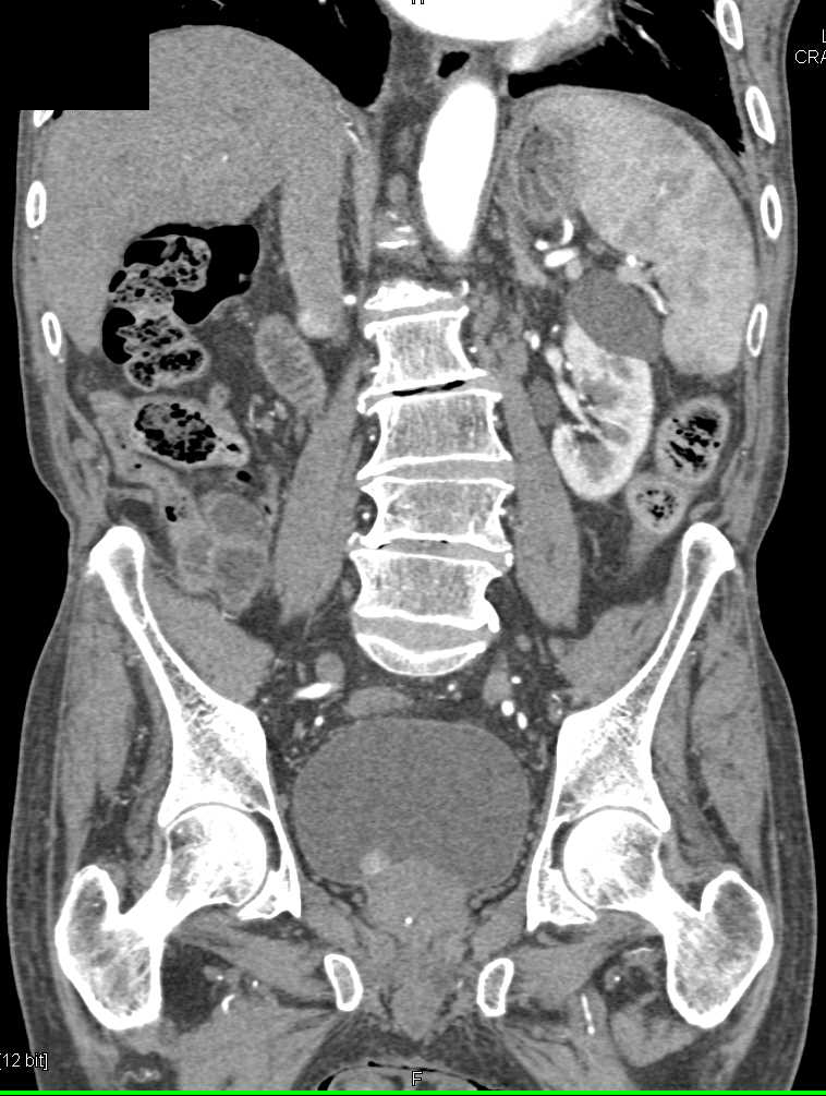 Incidental Bladder Cancer 1cm with Hemorrhage - CTisus CT Scan