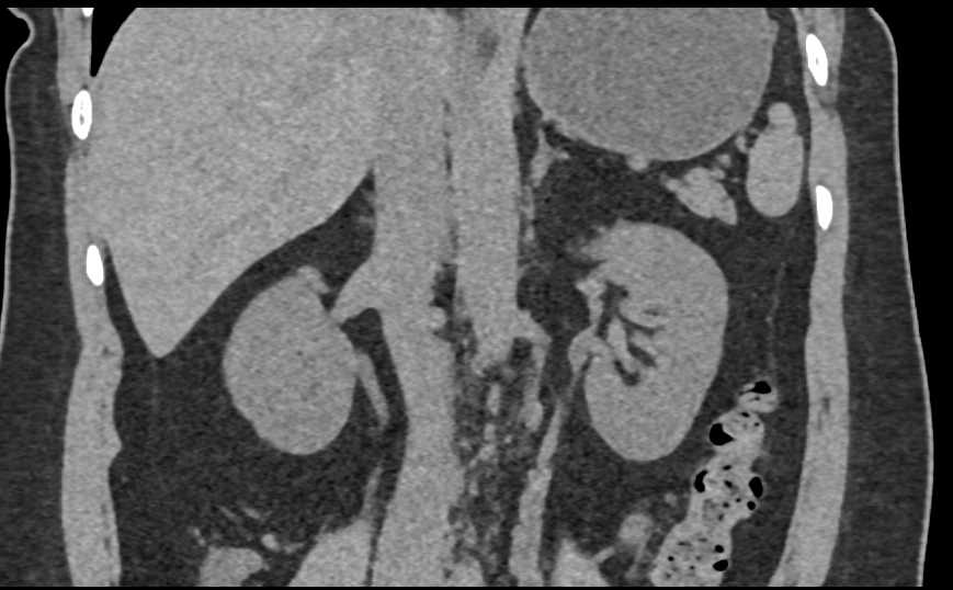 Varices Involve Left Ureter and Simulate a Tumor - CTisus CT Scan