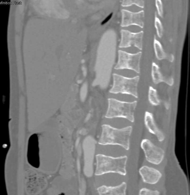 Paraganglioma with Vascular Enhancement - CTisus CT Scan