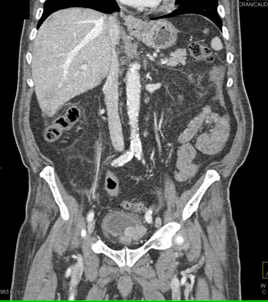 Bladder Cancer with Bleed - CTisus CT Scan