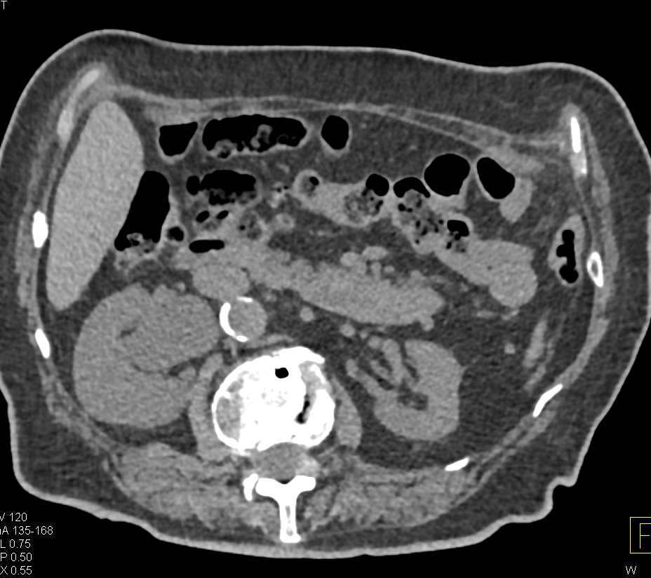 Aggressive Bladder Cancer with Extension Through the Bladder Wall - CTisus CT Scan