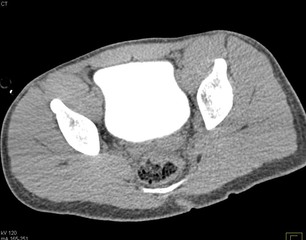 CT Cystogram Without Leak - CTisus CT Scan