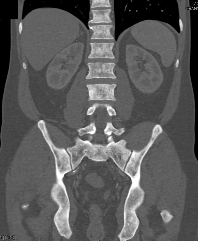 Bladder Cancer with Bone Metastases - CTisus CT Scan