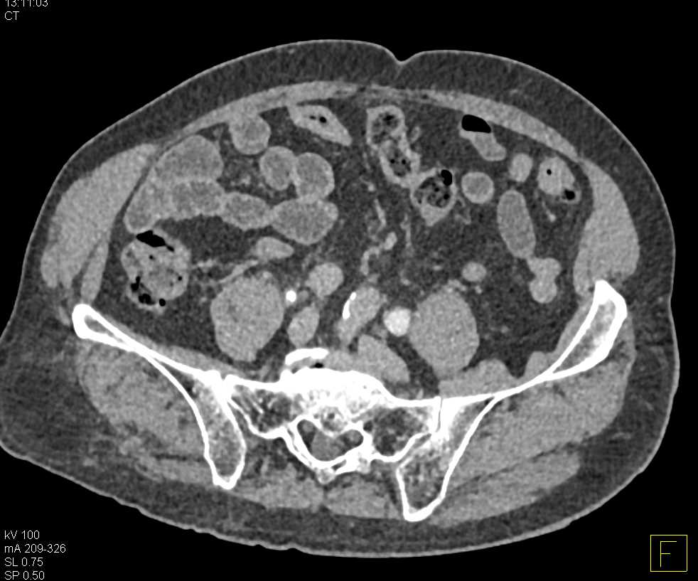 Bladder Cancer - CTisus CT Scan