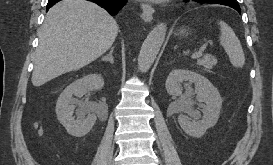 Aggressive Bladder Cancer with Bilateral Hydronephrosis - CTisus CT Scan