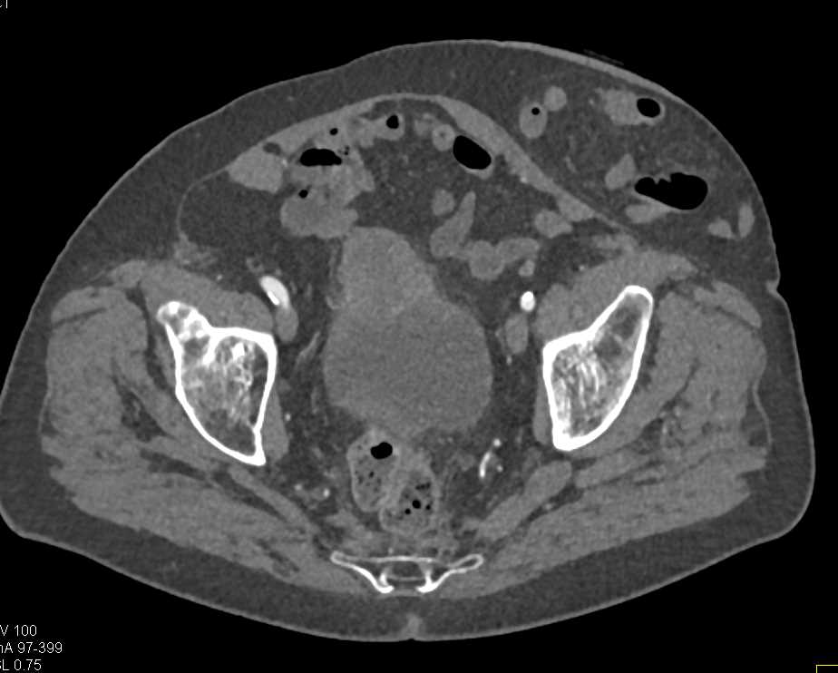 Urachal Carcinoma - CTisus CT Scan