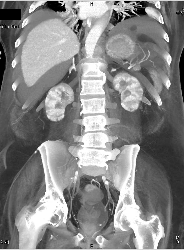 End Stage Renal Disease (ESRD) and Hemoperitoneum - CTisus CT Scan