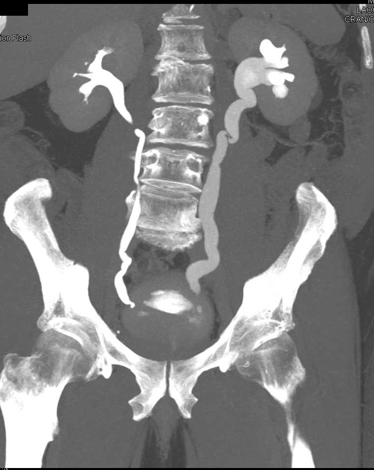 Carcinoma Distal Left Ureter Genitourinary Case Studies Ctisus Ct