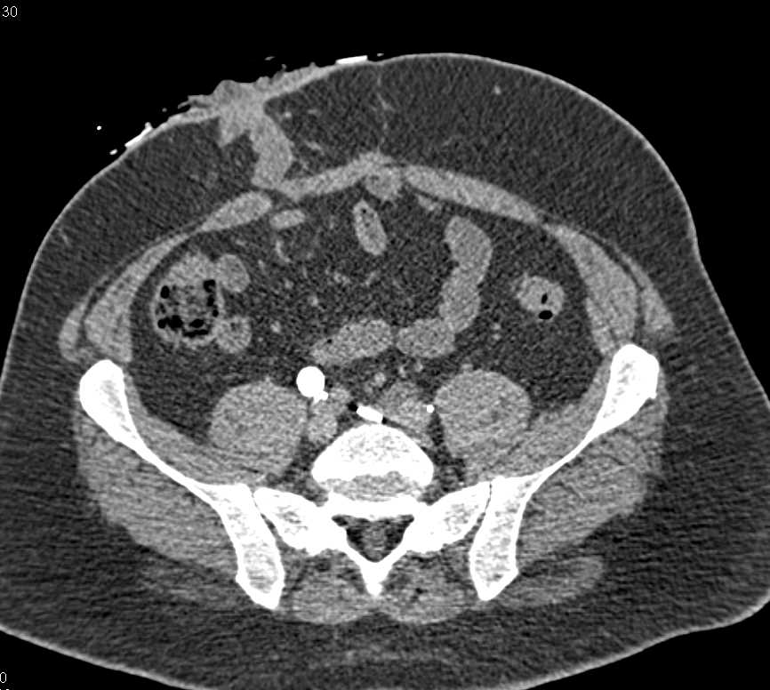 Left Hydronephrosis due to a Stricture - CTisus CT Scan