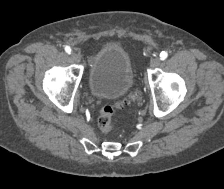 Bladder Cancer - CTisus CT Scan