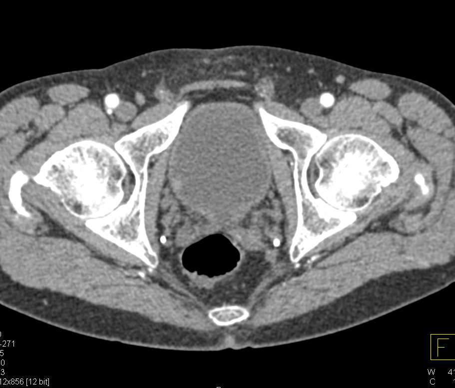 Incidental Bladder Cancer on Right Wall of the Bladder - CTisus CT Scan