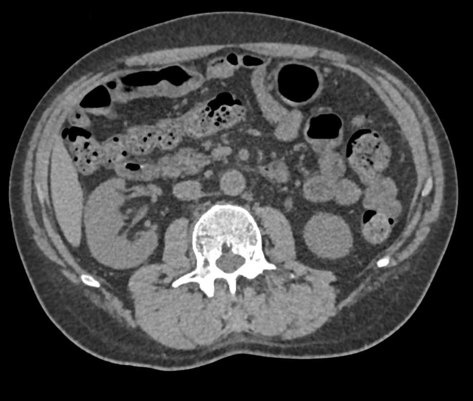 CT Urogram with Mild Medial Positioning of the Ureters - CTisus CT Scan