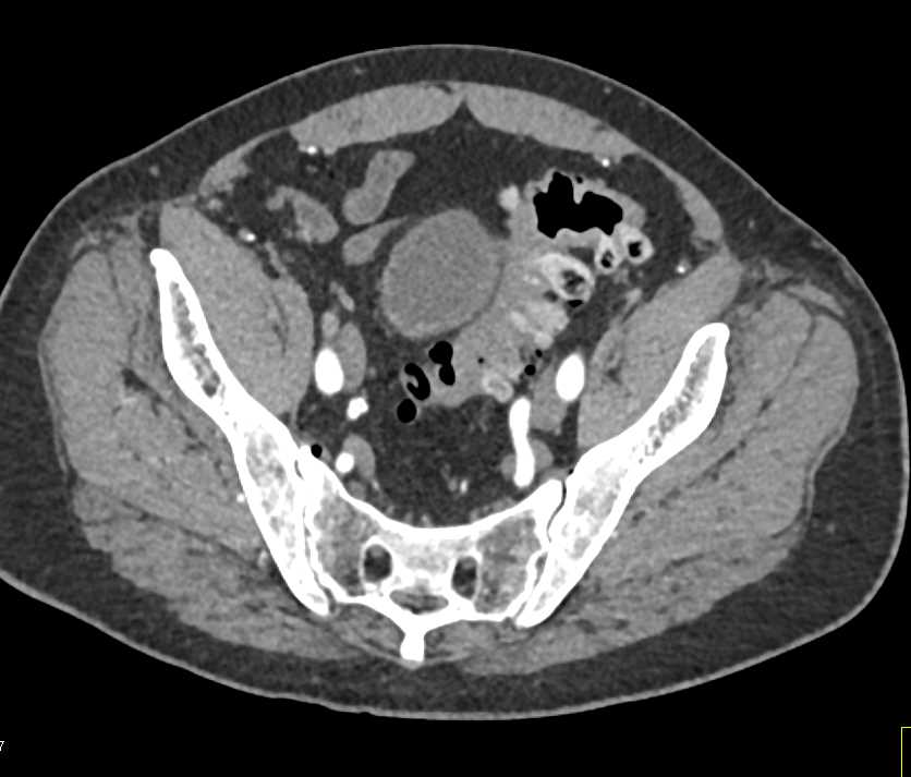 Bladder Calculi and Enlarged Prostate - CTisus CT Scan