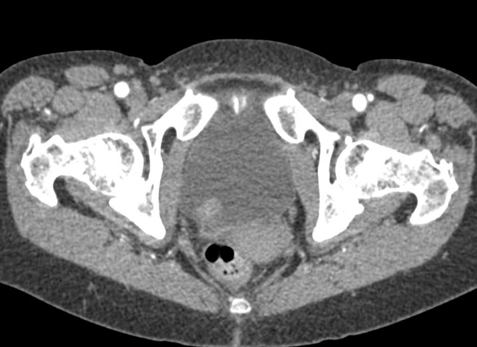 Incidental Bladder Cancer - CTisus CT Scan