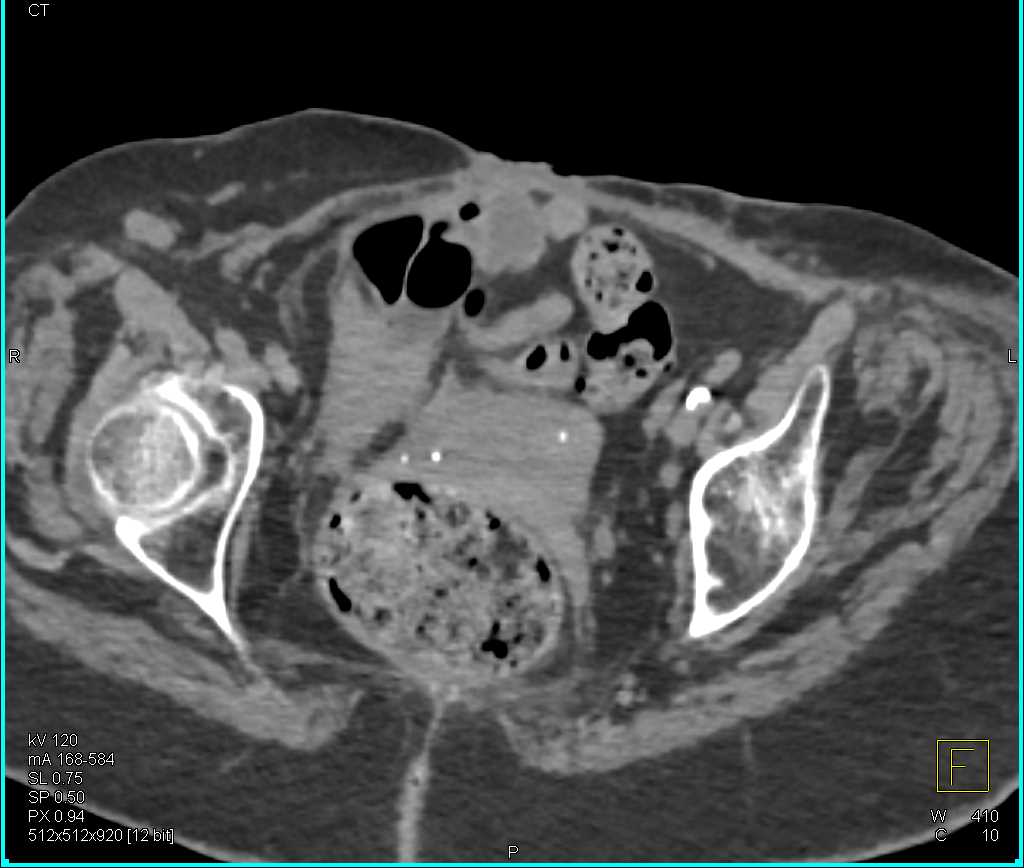 CT Cystogram with Active Leak from the Bladder - CTisus CT Scan