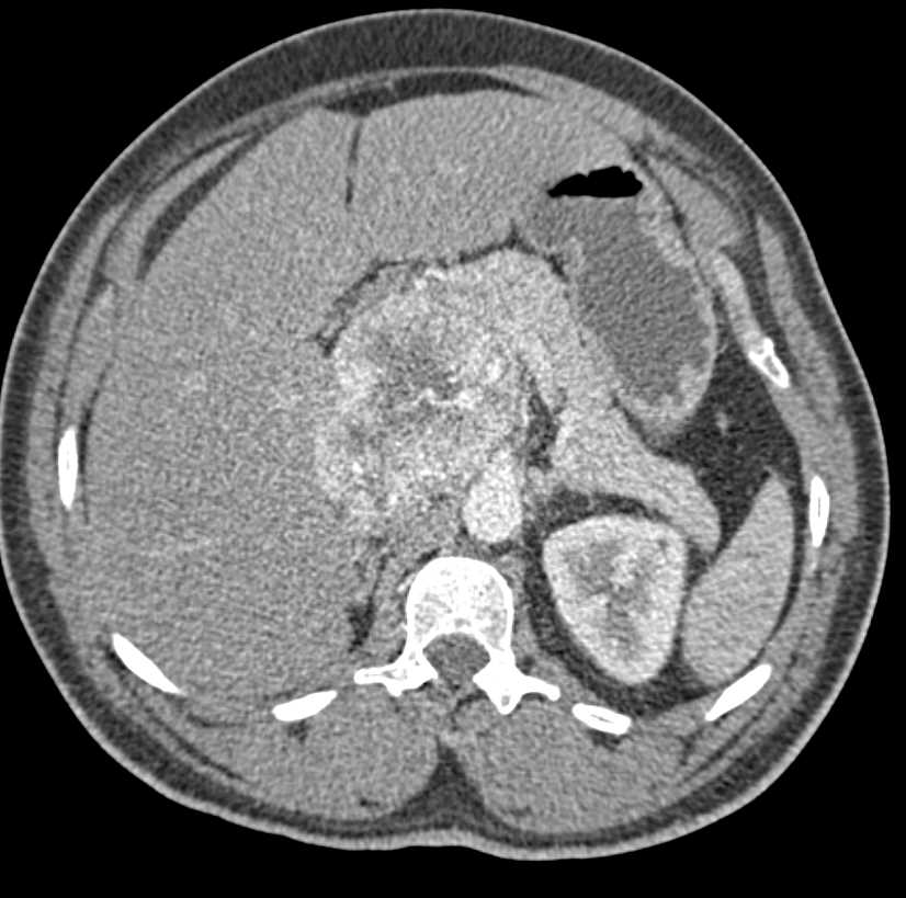 Paraganglioma - CTisus CT Scan