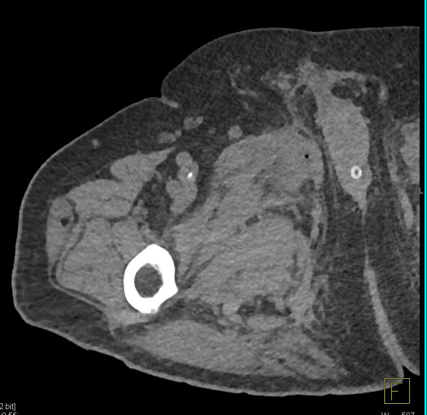 CT Cystogram with Fistulae from Urethra - CTisus CT Scan