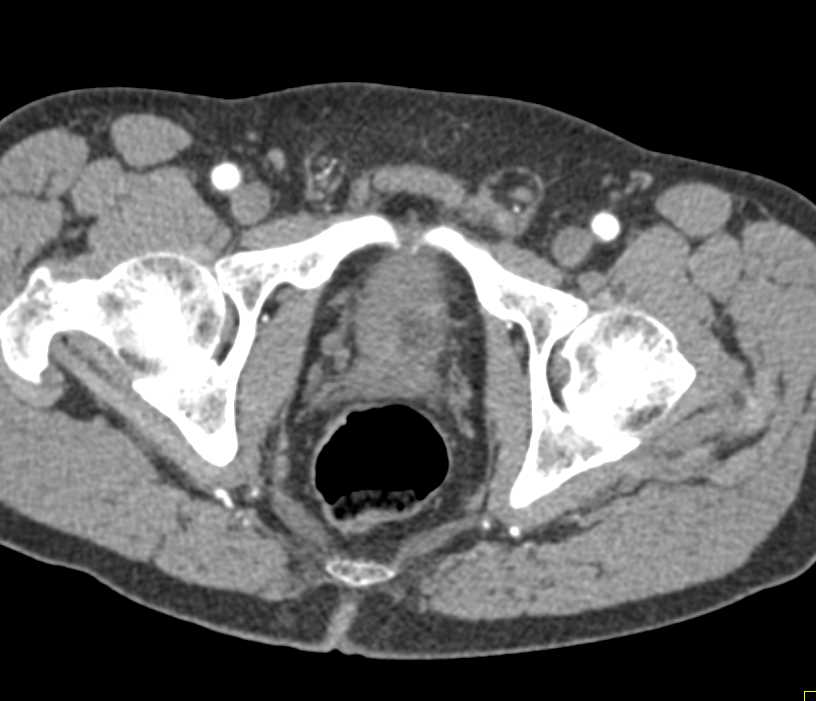 Prostate Cancer - CTisus CT Scan
