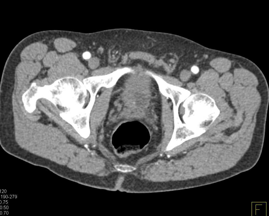 Prostate Cancer - CTisus CT Scan