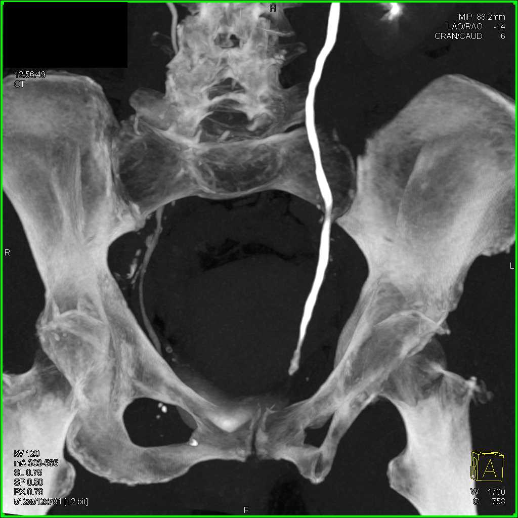 Transitional Cell Carcinoma (TCC) Distal Left Ureter - CTisus CT Scan