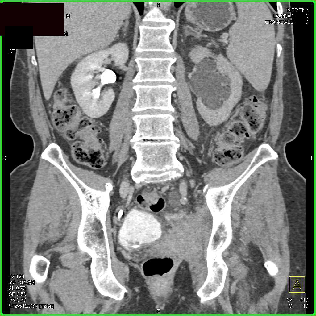 Bladder Cancer Involves the Left Pelvic Side Wall and Obstructs the Left Ureter. - CTisus CT Scan