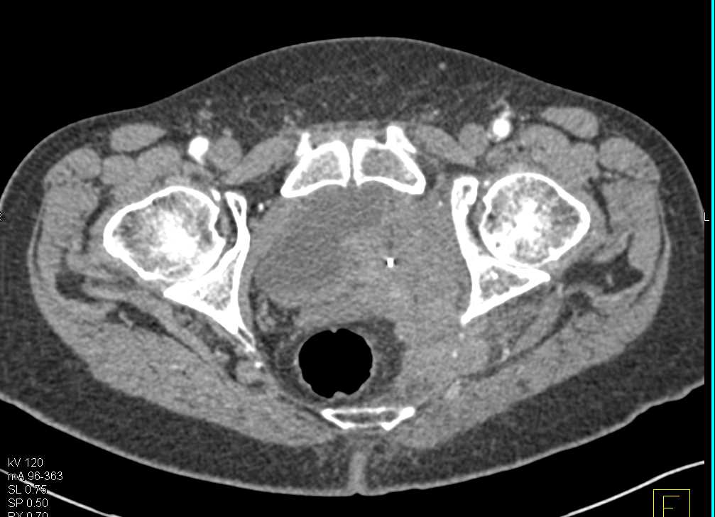 Bladder Cancer Involves the Left Pelvic Side Wall and Obstructs the Left Ureter. - CTisus CT Scan