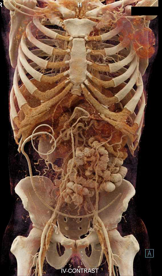 Peritoneal Dialysis Catheter with Cinematic Rendering - CTisus CT Scan